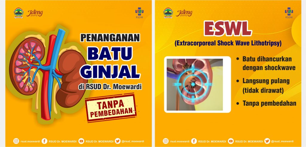 Penanganan Batu Ginjal Tanpa Pembedahan di RSUD Dr. Moewardi